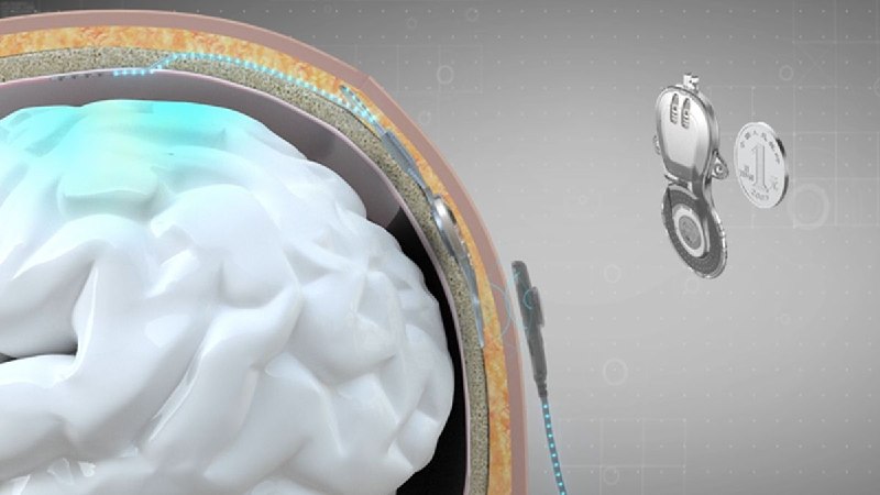 Китай обогнал Neuralink Илона Маска в создании первого в мире коммерческого имплантата интерфейса мозг-компьютер —